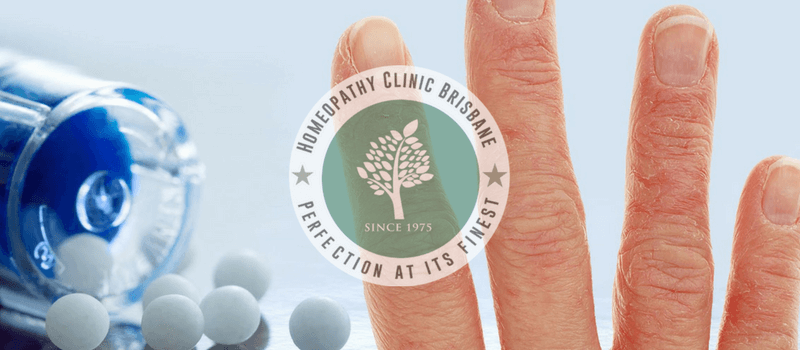 Homeopathy and its Role in Eczema and Atopic Dermatitis